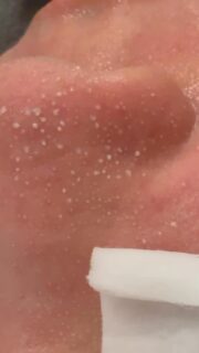 韓国式毛穴洗浄は
・毛穴の奥の汚れを浮かせる
・優しく吸引しながら除去する
・肌を引き締める
という3段階アプローチで行います🫧

ただ取るだけではなく
毛穴の環境そのものを整えるため
「戻りにくい毛穴ケア」が可能になります！

特にいちご鼻で悩んでいる方は必見です👀

一度の施術でもこのような効果が⬇️

✔ 小鼻のザラつきがツルツルに
✔ 黒ずみが明るく改善
✔ 化粧ノリが格段にアップ

敏感肌の方もご相談ください💁🏻‍♀️