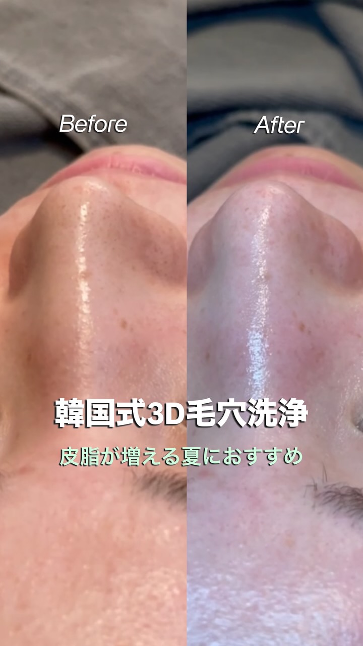 夏の皮脂トラブル、そのままにしていませんか？🫧

気温や湿度が高くなるこの季節は、皮脂の分泌が増えやすく、毛穴の黒ずみやざらつき、メイク崩れが気になる方が増えます💦

graceの韓国式3D毛穴洗浄は、毛穴に詰まった皮脂や汚れをやさしくケアし、なめらかでツヤのある素肌へ導きます✨

こんな方におすすめです🤍
✓ 毛穴の黒ずみ・角栓が気になる
✓ 肌のざらつきを感じる
✓ メイクノリを良くしたい
✓ ツヤのある素肌を目指したい

定期的な毛穴ケアは、美しい肌を保つための第一歩。

この夏は、自信の持てる素肌を一緒に育てませんか？🌿

ご予約はプロフィールのリンクから🔗